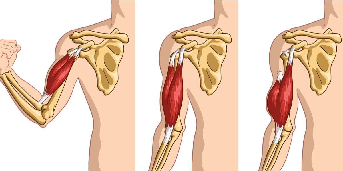 Proximal biceps tendon deals rupture